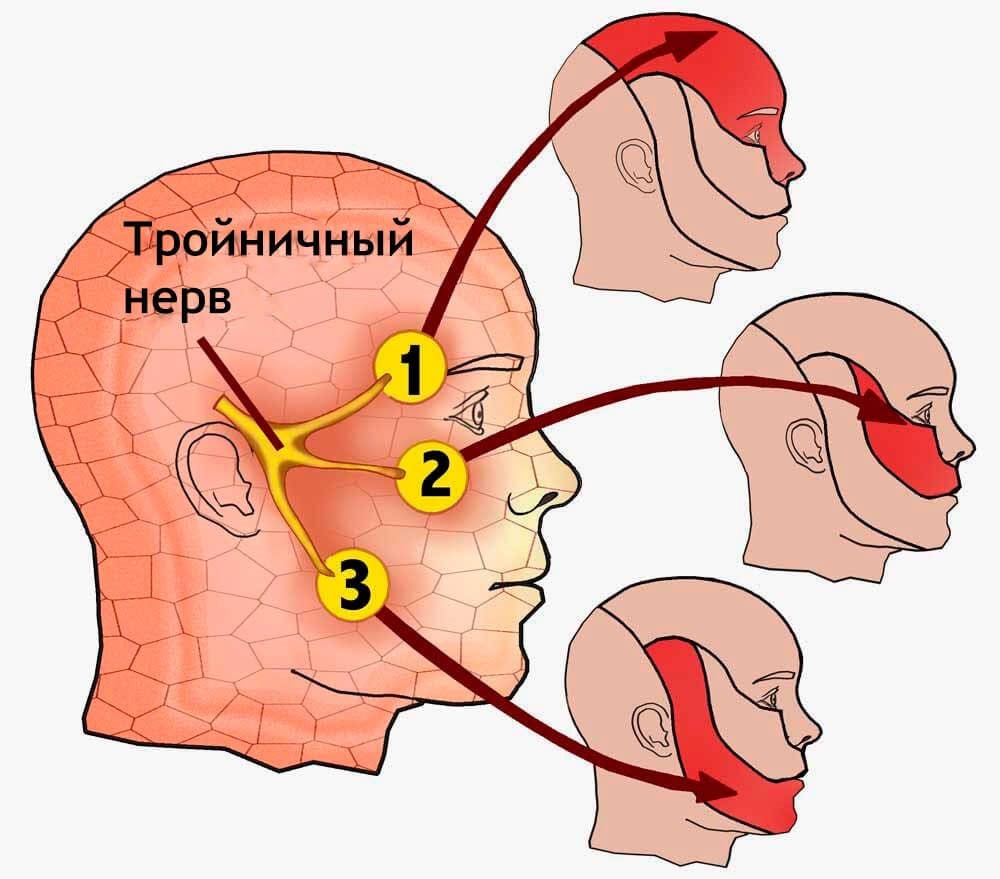 Воспаление тройничного нерва: симптомы лицевой невралгии, диагностика и лечение заболевания