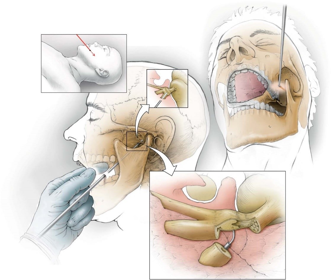 Воспаление тройничного (лицевого) нерва